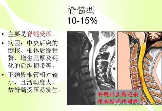 全面图解析颈椎病知识