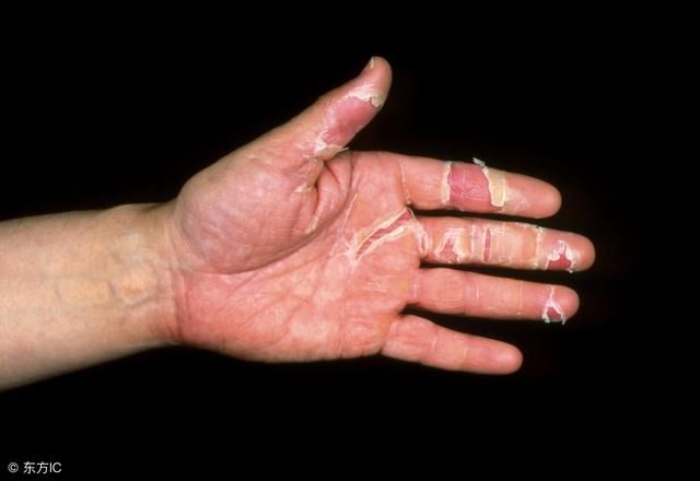 手癣 更严重的脱皮情况就是"手癣",一般是先有一只手出现脱皮现象