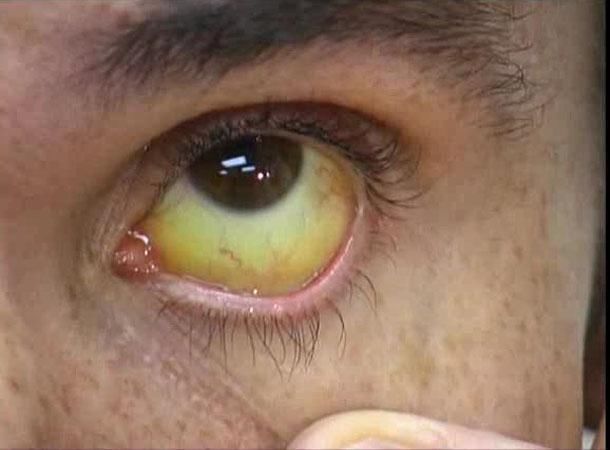 使其皮肤以及眼白逐渐发黄,这类症状被统称为黄疸