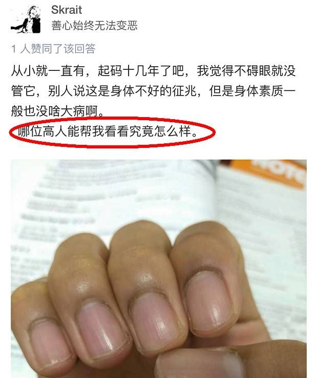指甲上有竖纹?小心你的身体出了错!