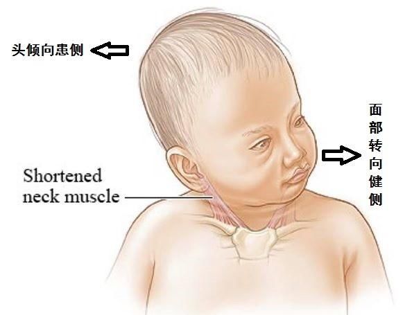 2,中度: 胸锁乳突肌紧张,但触摸没有包块;颈部运动受 ..