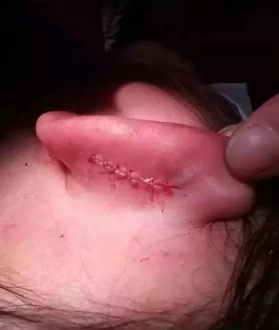 安徽某中心小学老师撕裂8岁女童耳朵,导致伤口缝