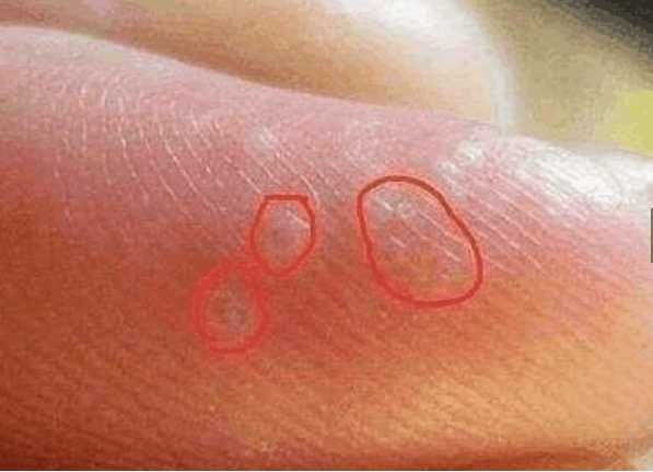 手上出现这种东西,赶紧去医院检查,身体可能出现问题了!