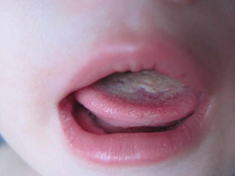 宝宝舌头健康"晴雨表" 舌苔由少变多,由薄变厚,变成一层厚厚的白垢物
