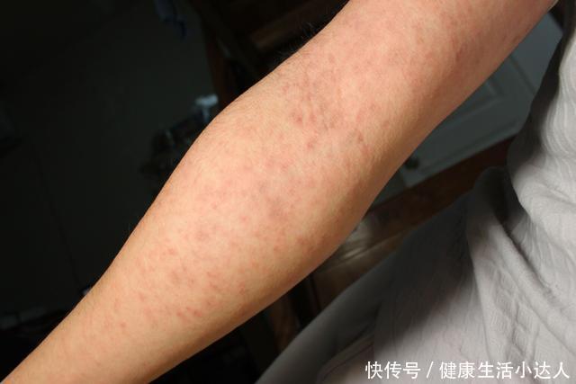 25岁女孩浑身起红疹,医生找不到病因,女孩低头说曾在东莞工作