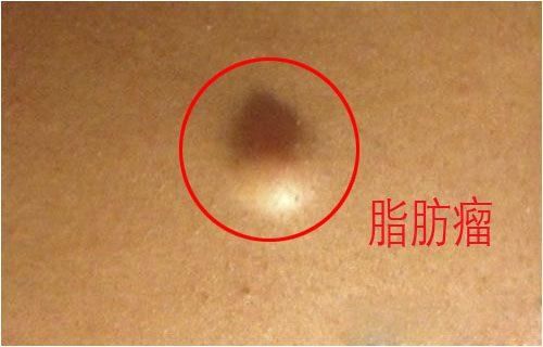 为什么人体会长脂肪瘤?你知道其中的原因吗?看完你还不注意吗?