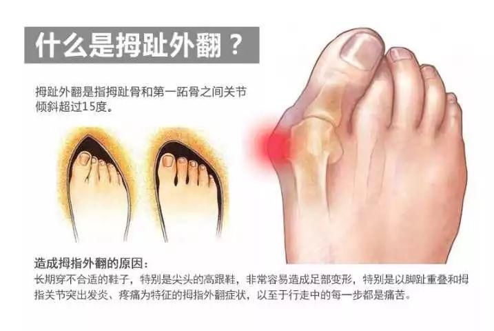 一些人的脚趾会出现拇指外翻的情况,拇指外翻就是指大拇指侧面的骨头
