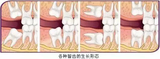 塞牙——智齿篇