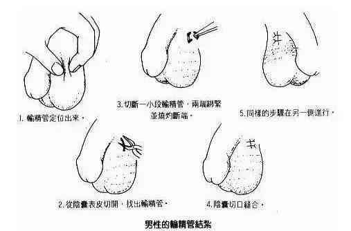 你肯定不知道: 男性结扎手术过程, 原来是这样的.