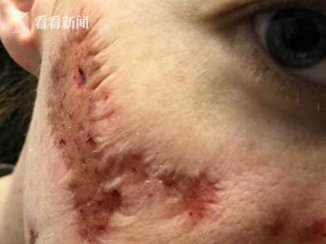 女子公厕用皂液洗手 脸部腐烂现坑洞如僵尸上脸