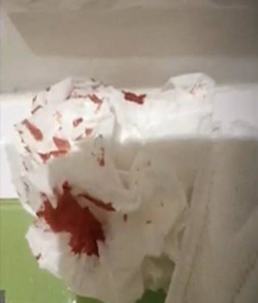 酒店浴室玻璃碎裂 女游客被碎片刺伤