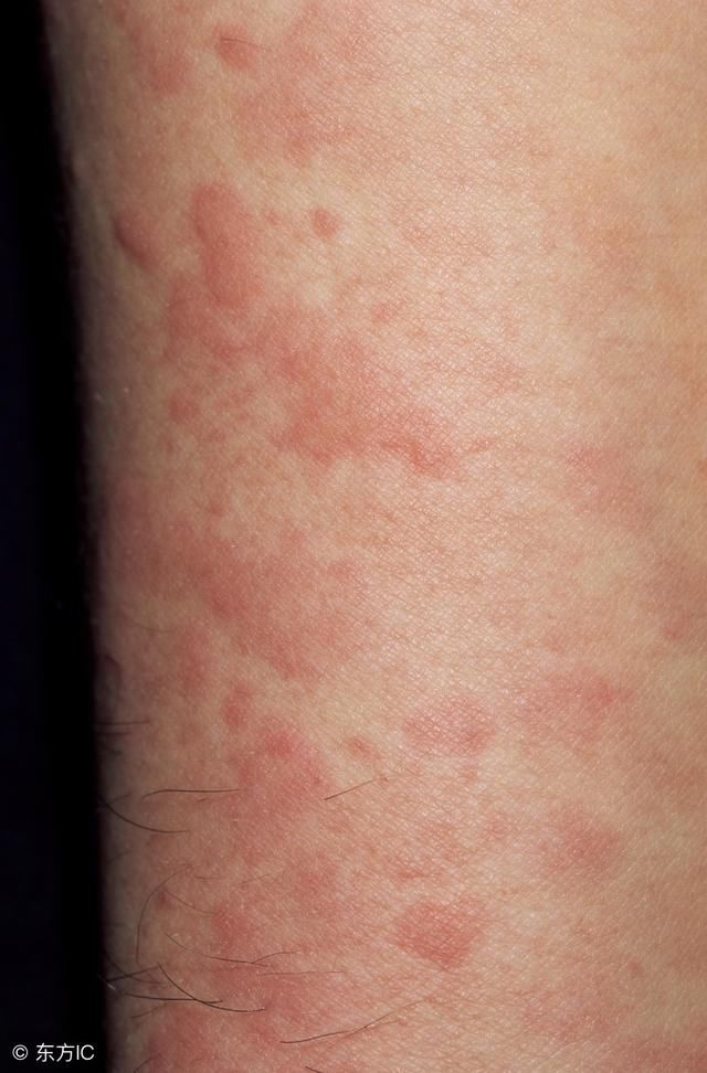 艾滋病aids真的有那么可怕吗?