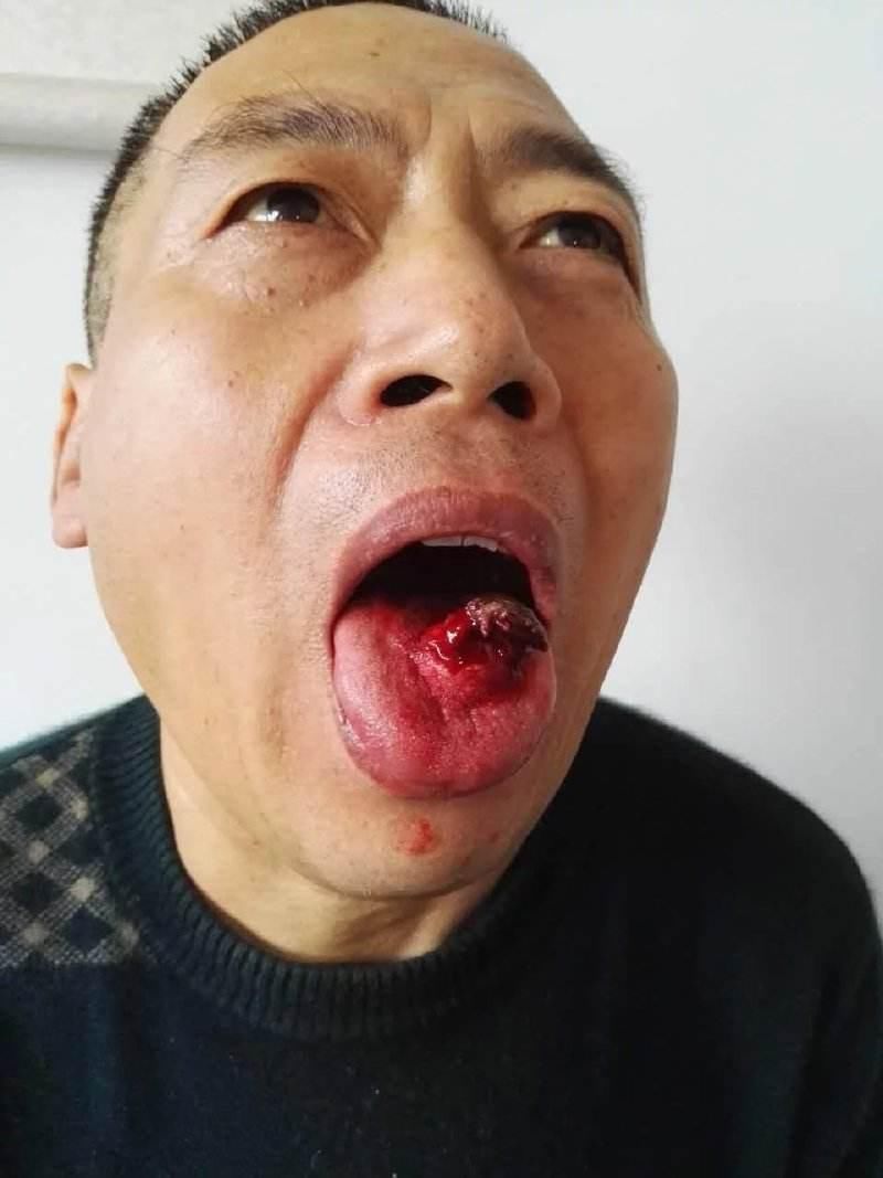 什么是口腔癌,怎么预防口腔癌?