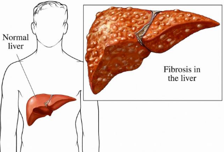 得了脂肪肝,这2句良言要谨记于心,否则肝脏会"坏掉"