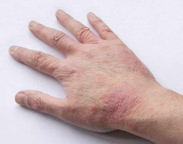 真菌感染引起的传染性皮肤病,一般手癣发病的初期会出现一些丘疹状的