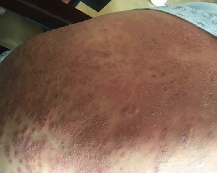 急性湿疹:皮损初为多数密集的粟粒大小的丘疹,丘疱疹或小水疱,基底
