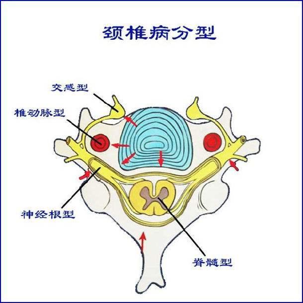 椎动脉与神经根同时受到波及,出现眩晕,手臂麻痛,称为混合型颈椎病.