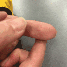 一个动作,竖起大拇指,看看指根就知道了 正常拇指:在五指中最粗,指根