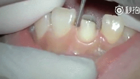 2)取模 送去加工厂之前,医生会给牙齿做一记录,为接下来的烤瓷牙生产