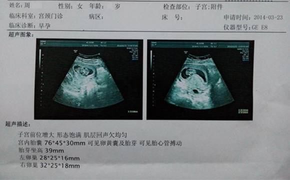 不用找人,b超单的这3项数据,暴露了你怀的是女宝宝