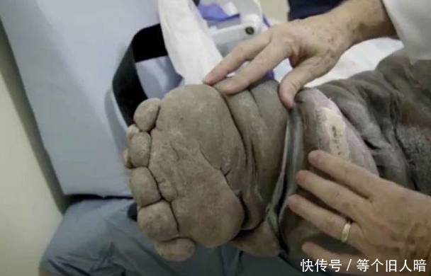 男子身体发生奇怪变异,大腿竟比大象腿还粗,得知真相