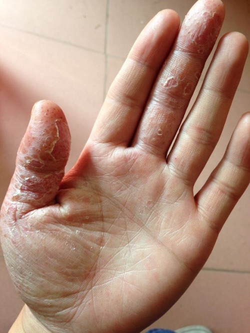 真菌性湿疹已经开始进入您的皮肤,真菌性湿疹在皮肤医学上是常见的