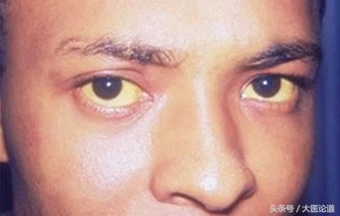 眼睛出现这些症状千万别忽视,很可能是大病征兆,尤其第9种