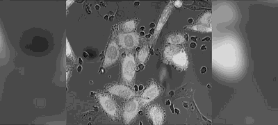癌症攻克更近一步?国内首个car-t疗法临床获批