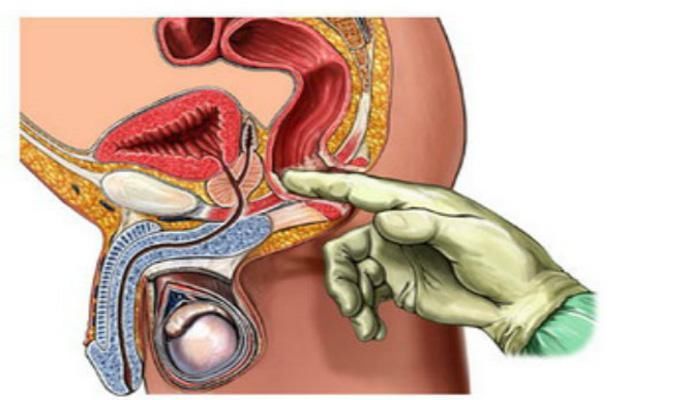 这是由"前列腺"所在的位置决定的,因为"前列腺"后面依直肠,所以有