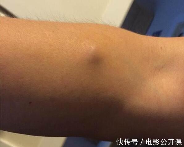 男子手臂出现"鼓包",剖开取出一物,医生当场傻了眼