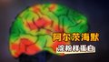 阿尔茨海默病因与脑内异常蛋白增多有关