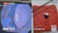 免开刀的“超级微创”