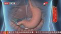 《养生堂》20250520酸多酸少 胃癌都增加