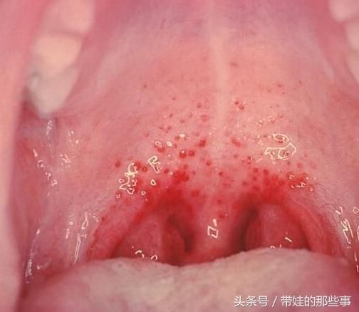 小区幼儿园又放假了!疱疹性咽峡炎凶猛来袭,孩