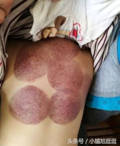 3岁孩子感冒发烧,婆婆偷偷给孩子拔火罐,宝妈