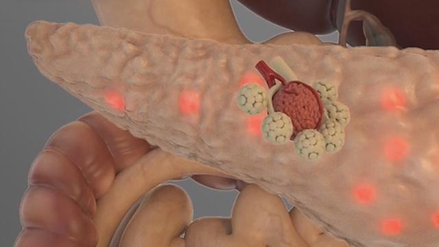 《养生堂》20170330饥饿感引发的致命危机 《养生堂》20170330饥饿感引发的致命危机