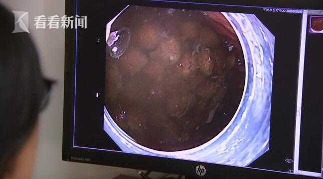 吴大哥今年50岁，是一名资深“杨梅控”，一个月前杨梅上市的时候，他就大吃特吃。吴大哥说，在他们老家有一个说法是“吃杨梅不吐核”，据说这样不仅能把肠道里的脏东西带出来，还可以促进消化。可是连杨梅带核吃了很多之后问题来了，前几天，吴大哥感到肠胃非常不舒服，胀痛难忍，连饭也吃不下，没胃口。受不了胀痛的吴大哥，只好跑到医院求诊。医生在做过胃镜后发现，在吴大哥的胃里居然有100多颗没有消化的杨梅核，它们都堵在胃里的幽门处排不出来，难怪会胀痛呢。