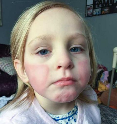 4岁女孩对任何事物过敏 甚至晒太阳都会肿起来