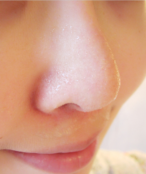 一次性挤出超多的黑头是一种什么体验