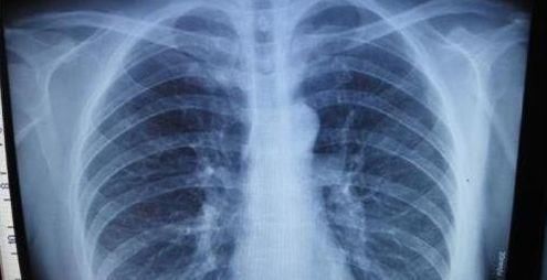 注意!肺癌早发现,光拍胸片可不够!你需要做的,