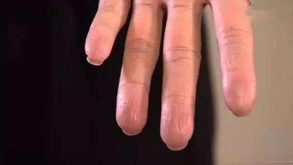 运动员永远的痛,詹姆斯的脚,孙杨的手,科比的手