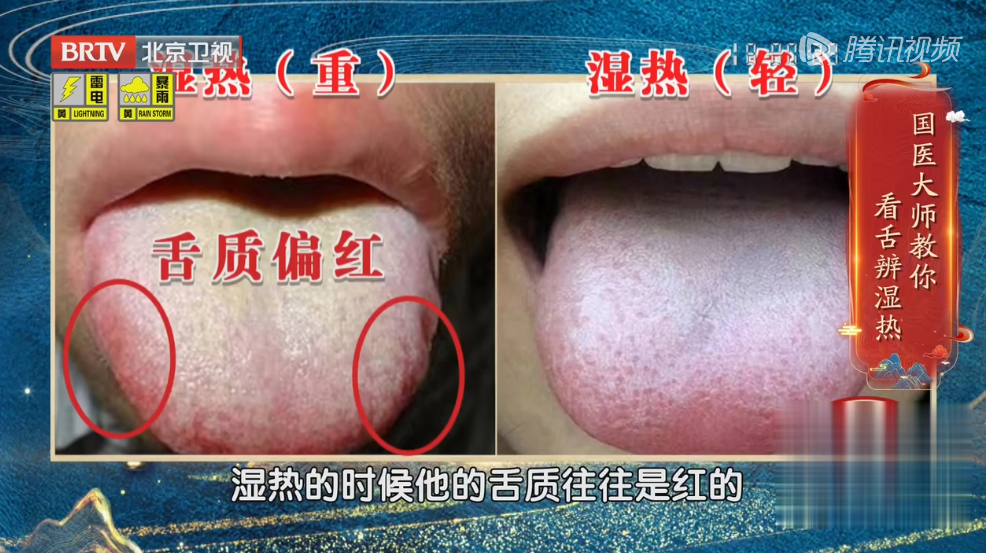 【湿气】寒湿还是热湿?看舌头就知道!_北京时间