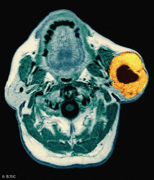 耳垂边突然长疙瘩,别掉以轻心,可能是这种瘤