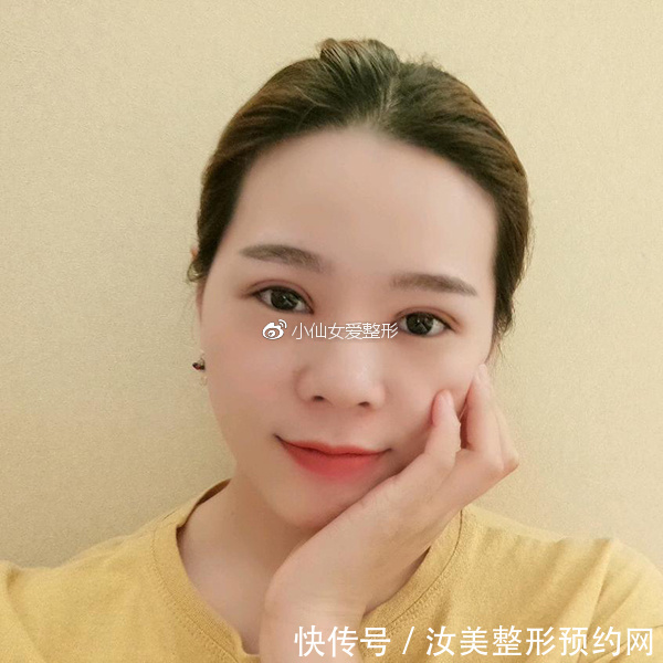 开内眼角前后对比照片,不灵不灵的大眼睛也着