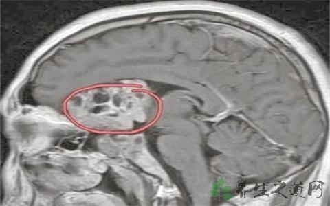 头部核磁检查副作用