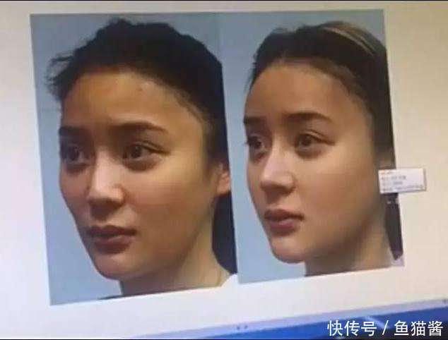 爆料整容医院不小心流出了袁姗姗整容前后对比
