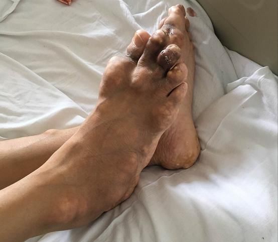 风湿科专家:4种食物是加重痛风升尿酸的"好帮手",不要再吃了