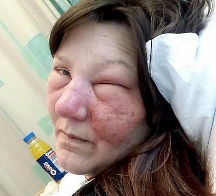 女子公园遛狗,突然感觉鼻子很痒,到医院检查后