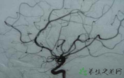 脑动静脉畸形吃什么药