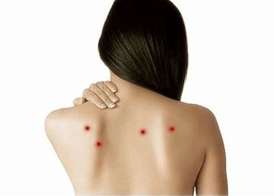 女孩胸前背后长痘痘6年不敢穿裙子 医生竟这样